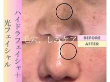 Cスキンケアクリニック 麻布店/ハイドラ+光フェイシャル