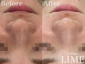 ライム 名古屋(LIME)/ハーブピーリング｜毛穴洗浄