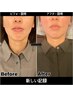 【小顔の悩みに】美肌・小顔骨格矯正プレミアム(院長施術)40分￥7,900