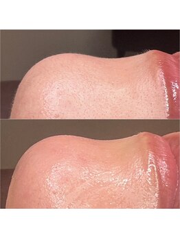 セレン(Seren)/顔wax脱毛で毛穴レスのお肌へ♪