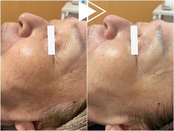 リコ(Ricco)/たるみシワ改善ハーブ★¥12990