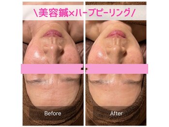 鍼灸院 はりのひと/美容鍼×ハーブピーリング