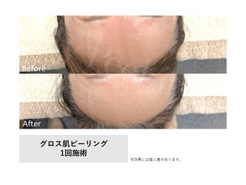 スリール(sourire)/Gloss肌ピーリング