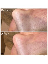 マドモアゼル 麻布十番/毛穴洗浄