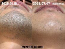 ルーチェ/【ヒゲ脱毛】半年でこうなる