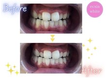 エクシアホワイトニング エミフルMASAKI店/ホワイトニングビフォーアフター