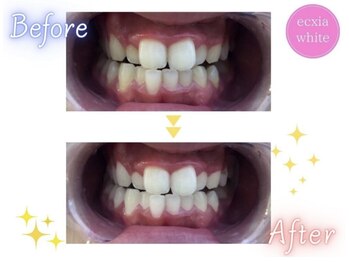 エクシアホワイトニング エミフルMASAKI店/ホワイトニングビフォーアフター