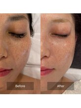 マインエム(mine.m)/シミ、シワ、ハリ/肌質改善