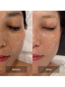 マインエム(mine.m)/シミ、シワ、ハリ/肌質改善