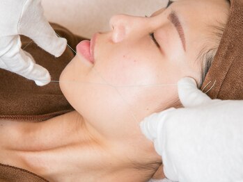 エスカル ボーテ(escale beaute)の写真/【お顔のシルク糸脱毛¥5500～】話題の糸脱毛★特殊な糸で自己処理では実感できないつるつる仕上がりに!!