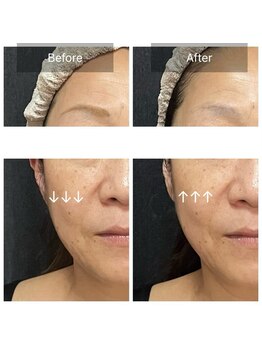 ジュエル シズオカ(JEWEL Shizuoka)/セルラムBefore After１回