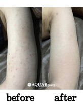 ビーエスアクアビューティー/脱毛