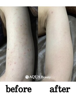 ビーエスアクアビューティー/脱毛