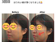ベル/20代の方の小顔Before After