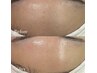 艶MAX！！！顔wax＆光脱毛＆沈静パック　スペシャル産毛ケア☆　6900円