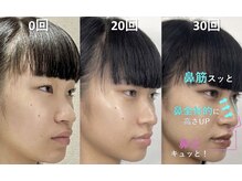 ラプリナーゼ 吉祥寺店(Raplit Nase)/隆鼻＋輪郭小顔矯正40分30回