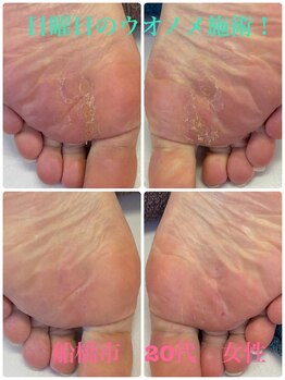 巻き爪じゅん 船橋店/日曜日にウオノメお願い！