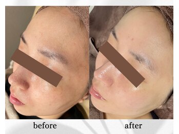 アン ビューティー(ann beauty)/リピーター様 30代女性