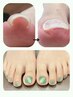 巻き爪の方必見★"巻き爪補正＋ワンカラ―ネイル〔Foot〕