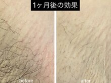 1ヶ月経っても生えてこないは、オウジュン脱毛の特徴です♪