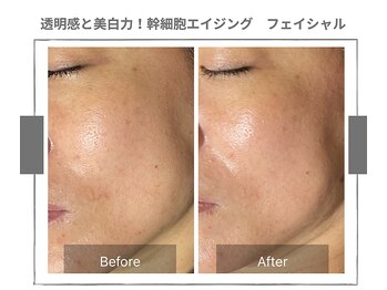 ラ ルーチェ 星田/幹細胞エイジング　フェイシャル