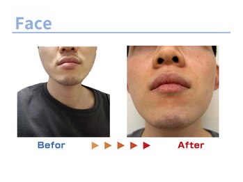 キングスサロン 熊本/メンズ髭脱毛ビフォーアフター