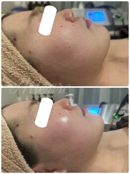 エルール トータルビューティ(Aileure total beauty)/インディバフェイシャル×小顔