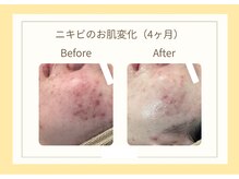 お肌結果にこだわります〔ニキビ/毛穴/シミ/シワ/たるみ/敏感〕