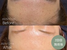 ラティエ(Latier)/ニキビ改善ハーブピーリング