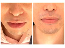 トゥルン(Tworun)/bifo　after