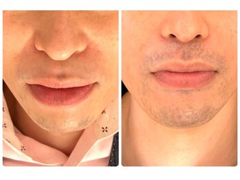 トゥルン(Tworun)/bifo　after