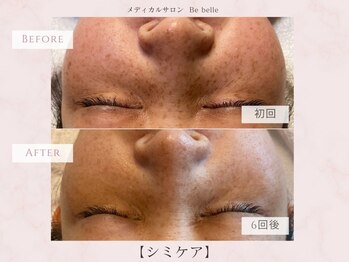 ビベル 八木店(Bebelle)/長年悩んだシミへアプローチ