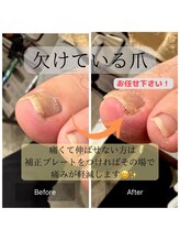 トラスト整体院 小池院/欠けた巻き爪も対応