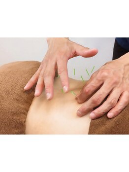 鍼灸施術を受けたい