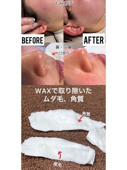 フローレンス(Florence)/フェイスWAX脱毛！ツヤスベ肌！