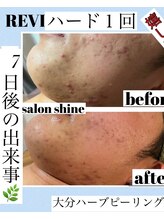 サロンシャイン(Salon Shine)/REVIハード１回