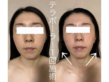 エクレクティック(ECLECTIC)/小顔/たるみケア/フェイシャル