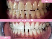 エクシアホワイトニング 札幌中島公園店/Before After［ホワイトニング］