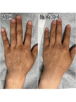 ルシャトン(Le Chaton)/指、手の甲脱毛