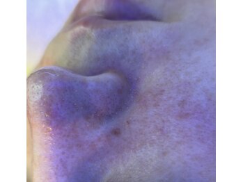 ビューティークリニックコダマ 都城店/見えない肌の中の汚れも!