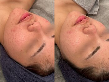 ポーデベロア(Peau des velours)/陶肌トリートメント