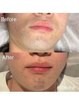 エピノン 山口岩国店(Epinon)/顔脱毛 ビフォーアフター