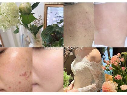 フォセット(fossette)の写真