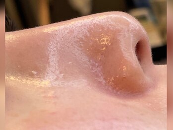 ハーシークレット(Her secret)/ハイドラ毛穴洗浄