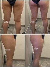 セラス(CERAS)/フォースカッター　太もも30分