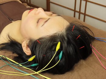 サンクエール 代官山鍼灸院(CINQ AILES)/施術風景　鍼のヘッドスパ