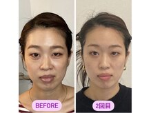 小顔22 ボルティ 赤坂支店(Bolty)/20代：小顔シンメトリー（2回）