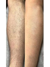 リムル(REMURU)/脚脱毛1回照射