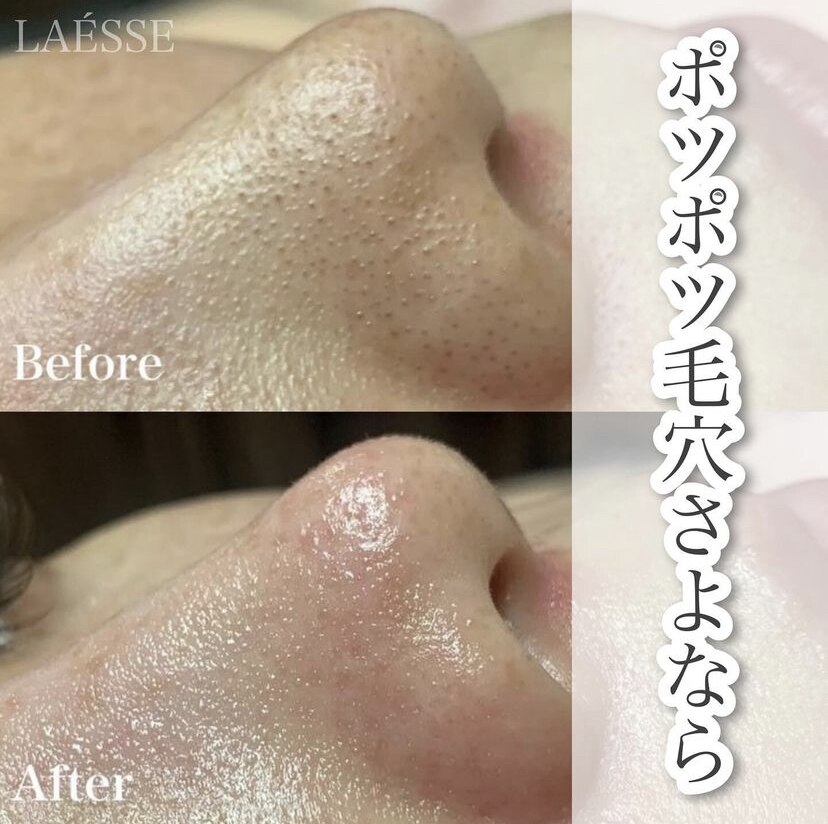 ラエッセ(LAESSE)｜ホットペッパービューティー