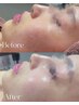 【回数券ご購入のお客様】毛穴・小顔・美白効果韓国最新美容！ララピール ¥0